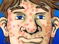 Juego Acne Be Gone